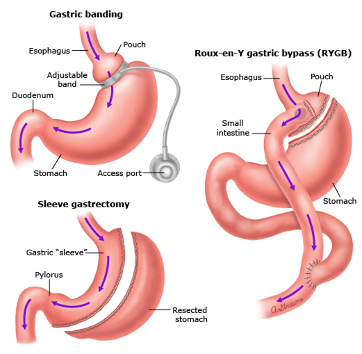 bariatric