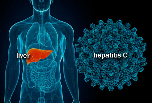 getty_rm_illustration_of_hepatitis_c