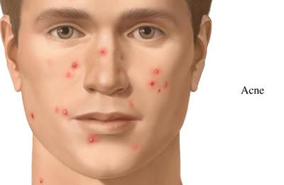 what-is-acne